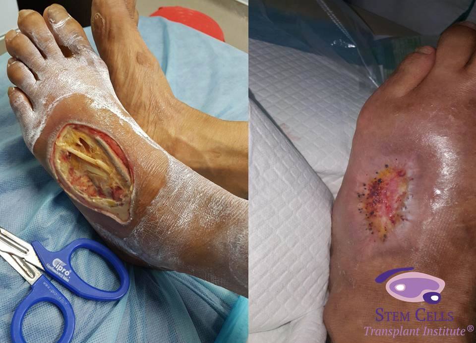MO HANEEF 2 Stem Cells mo h - Stem Cells Costa Rica