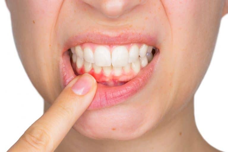 Gum Disease alzheimer's