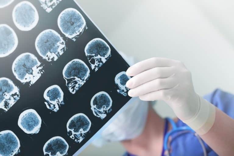 Stem Cells for Cerebral Artery Ischemic Stroke