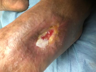 The patient’s wound on Feb 4, 2018 just before his final BMAC Procedure