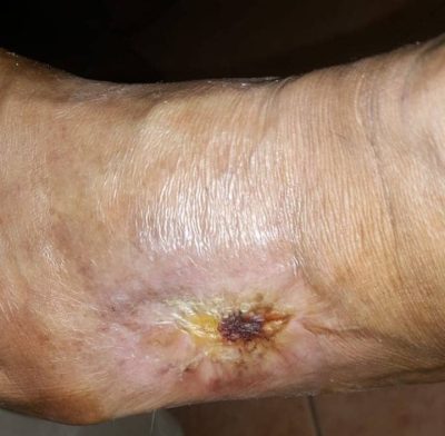 05 The wound as of May 15, 2018