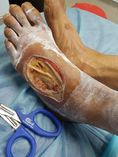 The patient’s wound upon discharge from hospital