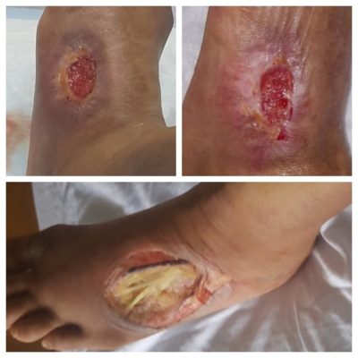 Bottom: Patient’s wound on Dec 12 upon first evaluation for stem cell procedure
Top Left: Patient’s wound 1 month post SVF Procedure
Top Right: Patient’s wound immediately following PRP